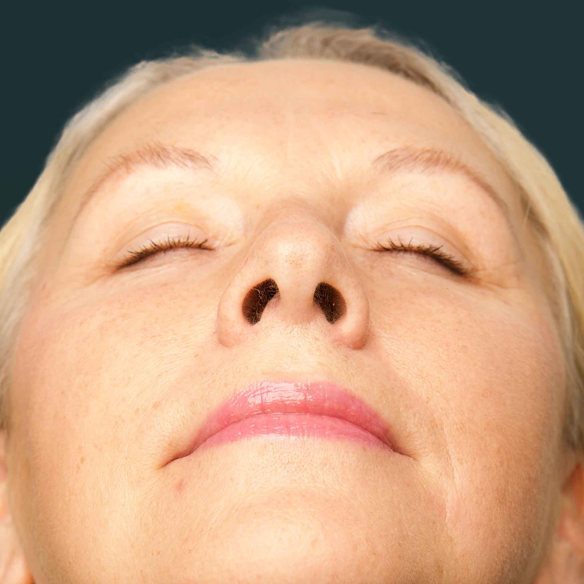 Septumplastik